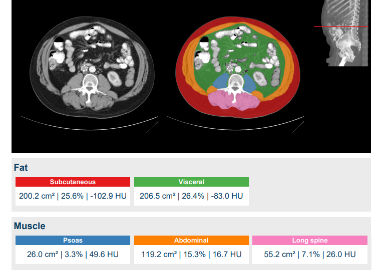 Quantib Body Composition Research Software